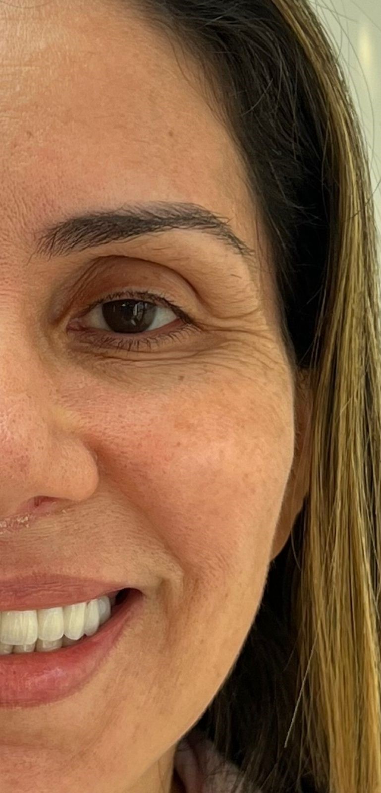 Tratamento Periocular