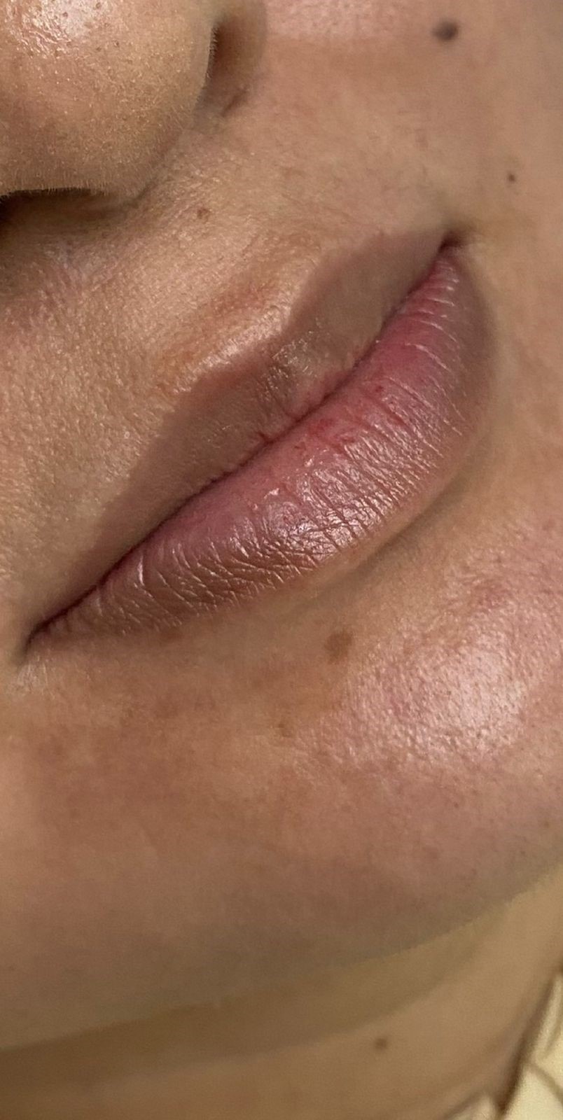 Preenchimento Labial